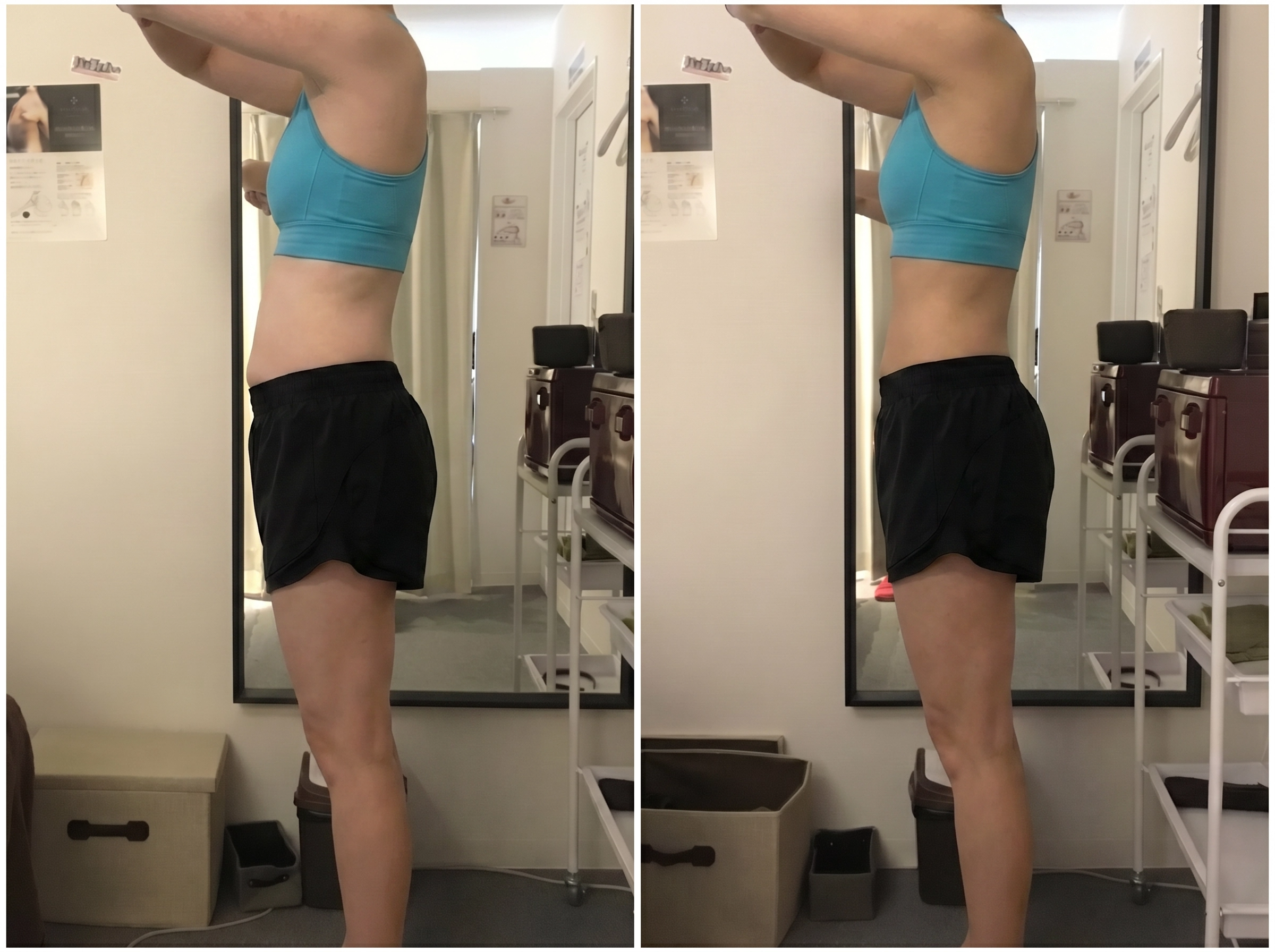 慢性腰痛改善 Before After